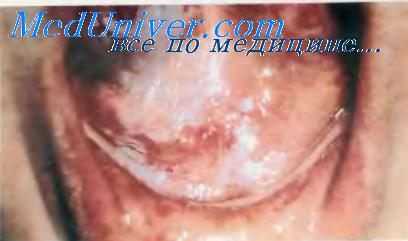 Плоскоклеточный рак полости рта