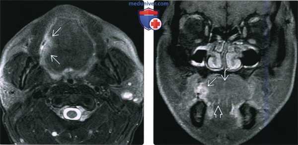 КТ, МРТ при плоскоклеточном раке тела и верхушки языка
