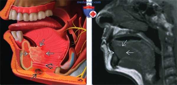 Плоскоклеточный рак дна полости рта - лучевая диагностика