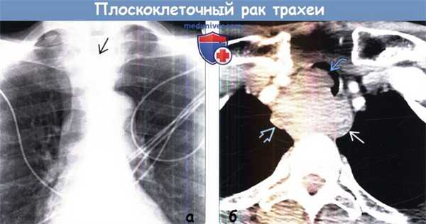 Плоскоклеточный рак трахеи на рентгенограмме, КТ