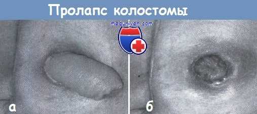 Пролапс колостомы