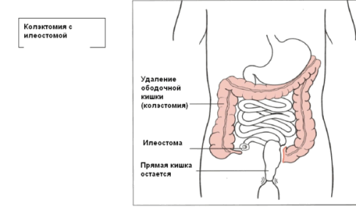 Колэктомия с илеостомой