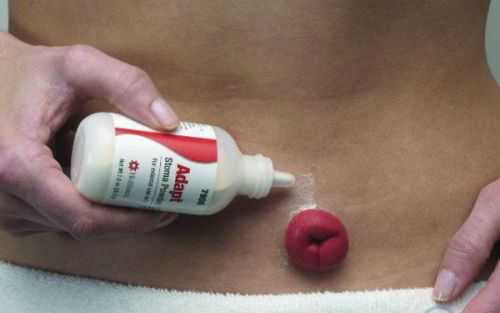 Выведенная стома