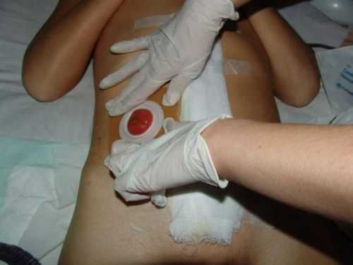 Привыкая жить со стомой, пациент может сталкиваться с проблемами