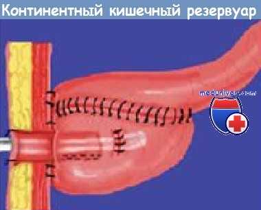 Континентный кишечный резервуар