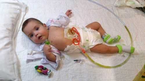 Синдром короткой кишки у ребенка