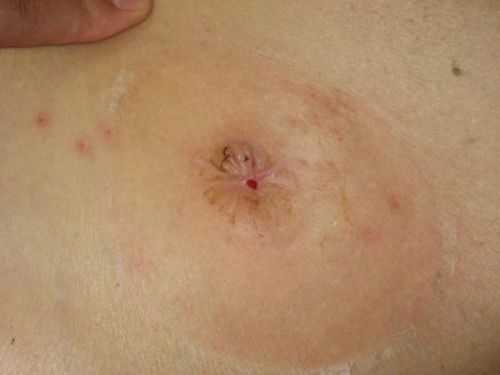 Вид закрытой стомы