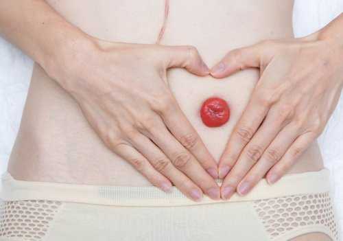 Что такое илеостома