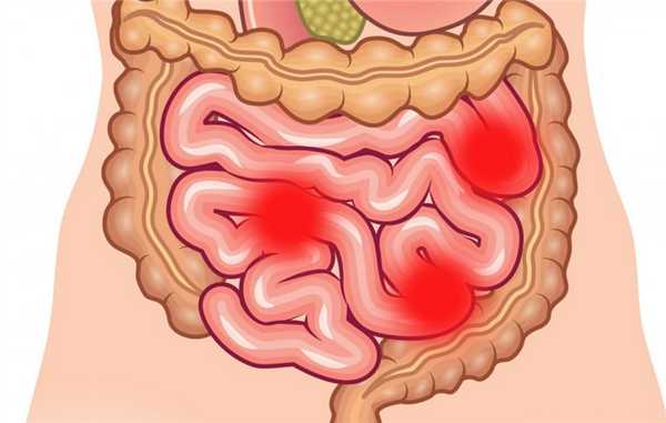 Илеостома при онкологических заболеваниях кишечника