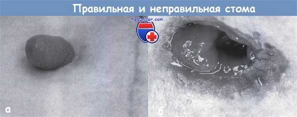 Стома кишечника