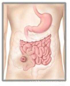 Илеостома дает возможность жить!