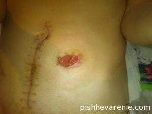 Нужно тщательно ухаживать за кожей вокруг илеостомы