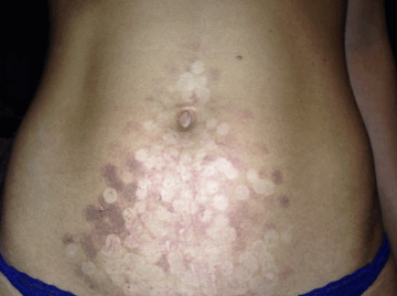 Синяки после лазерной эпиляции