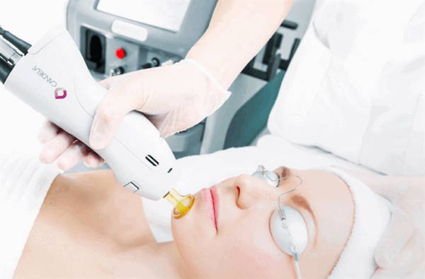 Лазерная эпиляция