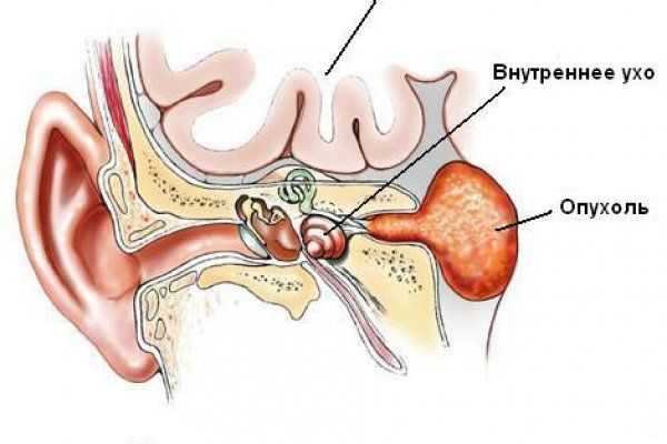 невринома уха