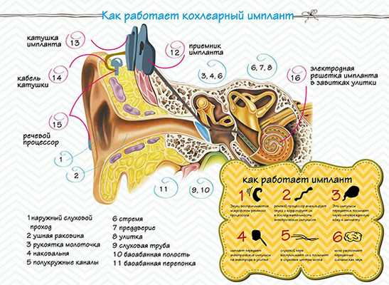 Как работает кохлеарный имплант