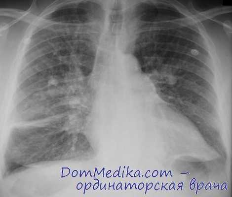 пневмокониозы