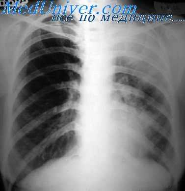 пневмомедиастинография