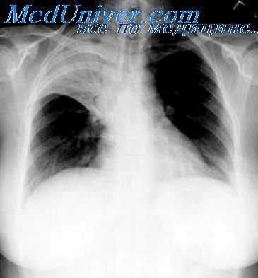 пневмомедиастинум