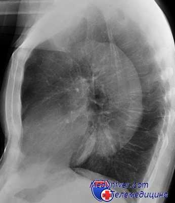 диагностика аневризм аорты