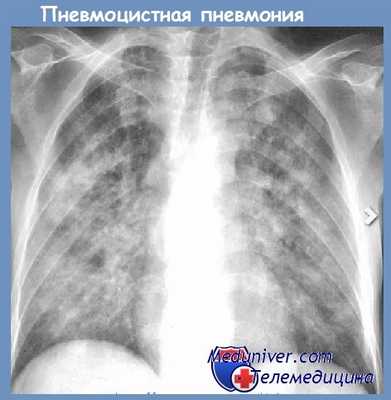 пневмоцистная пневмония