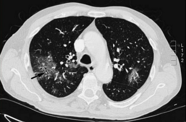 Пневмоцистоз