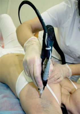 epilation3.jpg