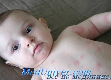 аллергия на антибиотики