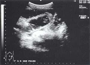 УЗИ: Расширенные петли тонкого кишечника до 3,5 см, заполненные жидким содержимым на фоне свободной жидкости в брюшной полости