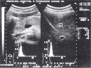 УЗИ: Острый панкреатит, повышение эхогенности поджелудочной железы (по сравнению с эхогенностью печени)