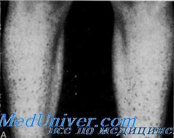 канальцевый ацидоз