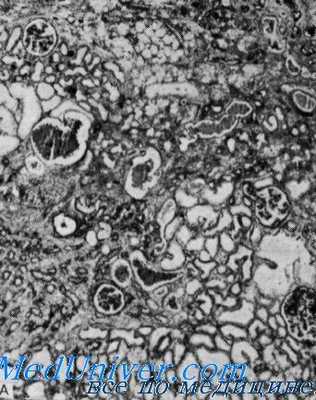 синдром альпорта