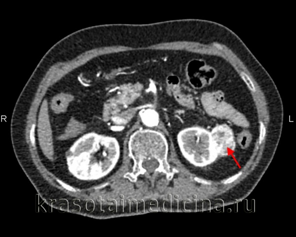 Почечно-клеточный рак