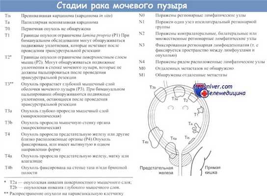 Стадии рака мочевого пузыря
