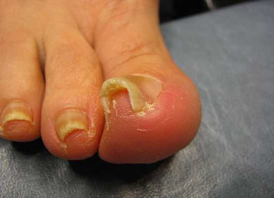 Вросший ноготь деформация