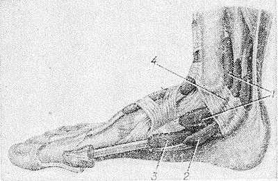 Рис. 5. Синовиальные влагалища сухожилий на медиальной поверхности стопы: 1 — синовиальное влагалище сухожилия задней большеберцовой мышцы; 2 — влагалище сухожилий длинного сгибателя пальцев стопы; 3 — синовиальное влагалище сухожилия длинного сгибателя большого пальца стопы; 4 — удерживатель сухожилий сгибателей.