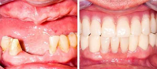 Установленный бюгельный протез на кламмерах до и после