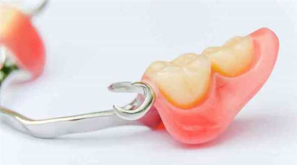 Бюгельные протезы с кламмерной фиксацией