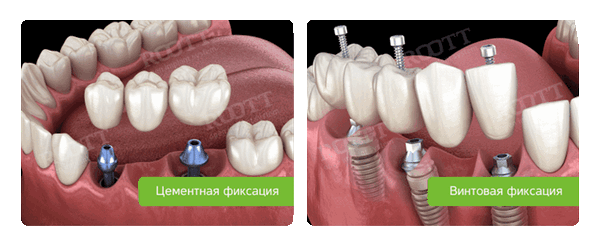 цементная и винтовая фиксация зубного моста