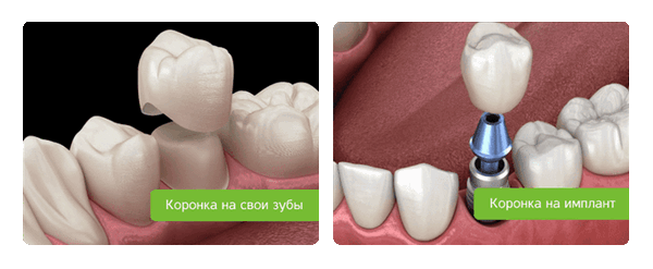 фиксация коронок на свои зубы и на импланты