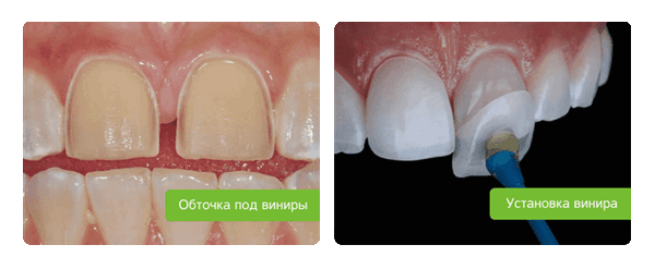 установка виниров