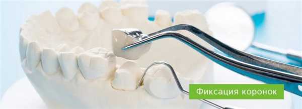 Фиксация коронок: методы крепления и материалы