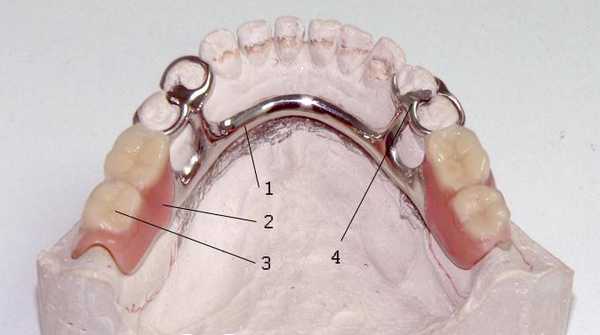 Понятие бюгельного протеза на кламмерах