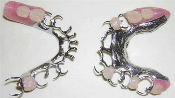 Шинирующий бюгельный протез