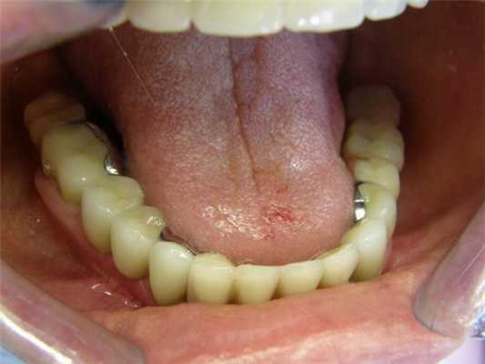 Преимущества бюгельного протеза на кламмерах