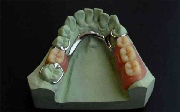 Конструкция бюгельных протезов с кламмерной фиксацией