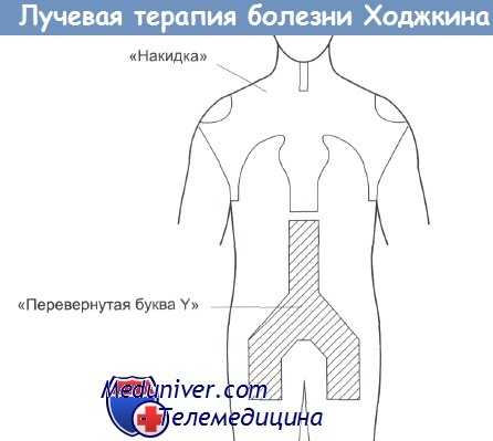 Лучевая терапия болезни Ходжкина