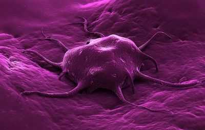 Лимфома Ходжкина