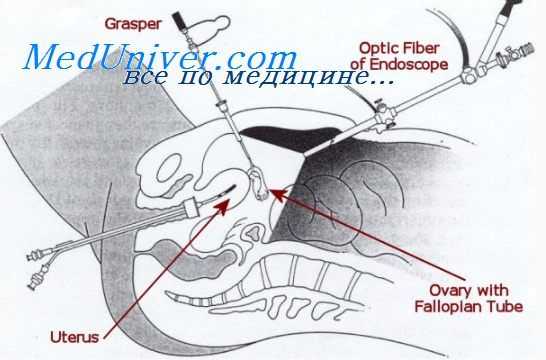 гистероскопия