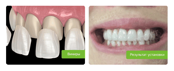 виниры